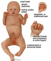 Pätau-Syndrom
° Hexadaktylie
° Mikrozephalie
° Dysplastische Ohren
° Lippen-Kiefer-Gaumenspalte