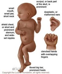 Edwards-Syndrom
° Fehlstellung der Finger (Zeigefinger & kleiner Finger überlagern Mittel- und Ringfinger)
° langgezogener Schädel
° "Faunenohren"
° Lippen-Kiefer-Gaumenspalte