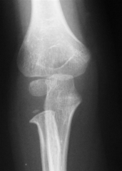 Hx:6yo B has R elbow pain p/ falling onto an outstretched hand 8 hrs ago.xrays are shown in Fig A. Overnight, he develops increasing pain and swelling in his R forearm. What associated condition can develop w/ the fx sustained in fig A? 1-EPL rupt...