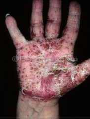 1.  Symmetric vesicular hand and foot dermatitis
2.  Moderate to severe pruritis
3.  Pain