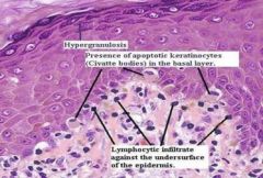 - keratinisation
- atrophy/hyperplasia
- band of chronic inflammatory cells
- lymphoctes and macrophages
- basal cell liquefaction
- Apoptosis
- saw tooth rete ridges