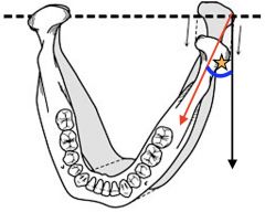 The angle formed between the anterior and medial movement of the non-working condyle and the straight protrusive path (s. Related to the degree of Bennet Movement.