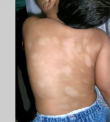1.  Associated with atopic dermatitis
2.  Asymptomatic, hypopigmented scaling plaque
3.  Common on face, lateral upper thighs, arms