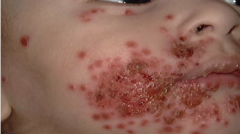 1.  HSV infection in AD patients
2.  MC in areas of active or recently-healed dermatitis