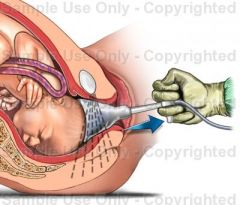 A Vacuum cup is placed on the fetal scalp and a suction device is connected to the cup to create a vacuum seal
Conditions necessary for safe use include: complete cervical dilation, ruptured membranes, engaged head, at least +2 station, absolute k...
