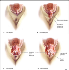 1st degree- involves only the perineal mucosa or skin
2nd degree- extend into the perineal body but do not involve the anal sphincter
3rd degree- extend into or completely through the anal sphincter
4th degree- tear into the anal mucosa (this incl...