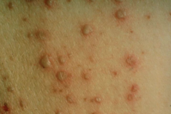 1.  Crops of lesions progress rapidly from:
2.  Red macules-->papules-->pustules-->crusts