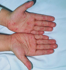 1.  Small, fragile vesicles with red areolae on palms/soles and other surfaces
2.  Fever, malaise, arthralgias