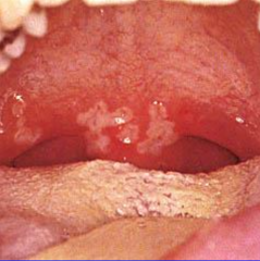 1.  Few grayish papules-vesicles with erythematous areolae on tonsils, soft palate, uvula, and tongue