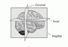 Sagittal section: divides the brain into right and left (hemispheres) 
Coronal, frontal transverse section: divides brain into front and back 
Horizontal (axial) section: divides brain into upper and lower