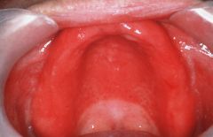 - red

- abx stomatitis
- denture stomatitis
- think diabetes/HIV/ immunosuppression in young and otherwise healthy pt