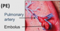 pulmonary artery obstruction with a blood clot