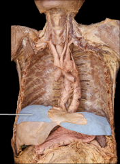 Thoracic cavity expansion