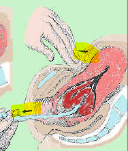 Pushing on abdomen + holding onto placenta 