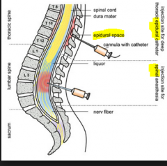 Spinal - paralysis + single INJ 


 


Epidural - pain relief + Catheter in place for future top ups 