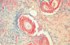 Amyloidosis:
- Congo red stain shows amyloid deposits within vessel walls