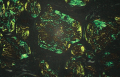 Amyloidosis
- Congo red stain shows apple green birefringence under polarized light
