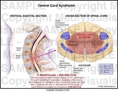 -MOI = hyperextension injuries with minor trauma to cervical region


-results in damage to central aspect of SC affecting UE sensation and motor functioning with normal LE functioning 