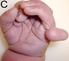 typical hand to which syndrome? 
what other clinical features? 