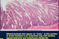 - Protein-losing enteropathy
- Congenital (lymphatic vessels underdeveloped) or acquired (obstruction from granulomatous or neoplastic disease).
- Diarrhea, steathorrhea (fat in stools), hypoproteinemia, ascites.
- Thickened intestinal mucosa, di...
