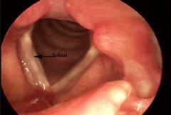 Aka sulcus vocalis. On the free margin, there is a depression on both vocal cords. This is due to an atrophy of the mucosa, and the mucosa is attached to  the  vocal  ligament,  so  you  don’t have mucosal wave where the mucosa is attached...