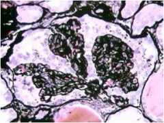 What is the stain? What is the type of FSGS?