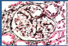 What is shown here? Does proteinuria remit with treatment? What is more likely on the biopsy? Prognosis?