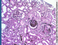 What is shown here? Does proteinuria persist despite treatment? What is more likely on biopsy? Prognosis?