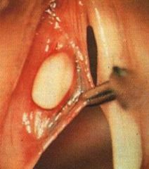 Congenital: open or closed epidermoid cyst 

Acquired: mucosal or retention cyst.  
On the vocal cords, we have salivary glands, and if the ducts of these salivary glands close you can have a retention cyst. 

The treatment: always speech thera...