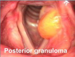 Typical of gastroesophageal reflux disease (GERD). You see this kind of ulcer, granuloma, on the vocal process. 
The treatment: first of all there is the treatment of GERD, so prokinetics, food hygiene, proton pump inhibitors (PPI) and so on. 
O...