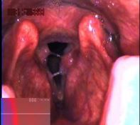 Laryngeal papilloma: the papillomatosis of the larynx, caused by HPV, could be of the adult type (usually there is only one lesion) but we can have also the juvenile papillomatosis that is interesting not only the vocal cords but also the tracheo...