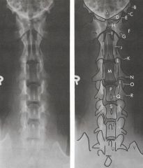 VD Cervical Spine