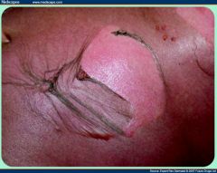 Séparation de l'épiderme lorsqu'on applique une pression sur la peau

- TEN
- SSS
- pemphigus vulgaris