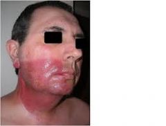 cellulite et lymphangite de la peau du à SGA
visage + fréquent