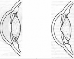 Mutation in type IV collagen: thinning and splitting of the glomerular basement membrane. Most commonly X-linked. 


 


 


Glomerulonephritis, deafness, and, less commonly, eye problems (cataracts/anterior lenticonus). 


 


 


 


 