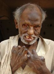 Leprosy (Hansen disease)