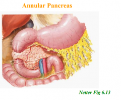 -failure of full rotation. descending portion of duodenum surrounded by pancreatic tissue, can become obstructed.