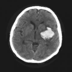 1. CT scan of the head diagnoses 95% of ICH
2. Coag panel and platelets -- look for bleeding diathesis