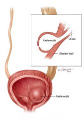 
cystic dilatation with obstruction from a pinpoint ureteral orifice; mostly girls
