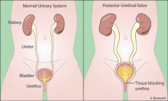 
--most common cause of severe obstructive uropathy
--boys
--can lead to ESRD
--mild hydronephrosis to severe renal dysplasia
--palpable distended bladder and weak urinary stream