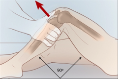 ACL tear


 


Flex hips and Flex knees to 90 degrees with feet flat


Cup hands around knee with thumbs on medial and lateral joint lines


Draw tibia forward and observe sliding forward


 


Forward jerk showing contours of upper ...