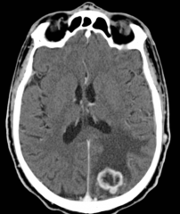 Bilde av en malign tumor i hjernen. Hvilken type tumor er dette mest sannsynlig?
