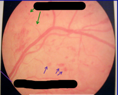 A fundoscopic exam with these findings would indicate what diagnosis?