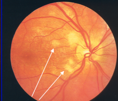 These lesions are also associated with Diabetic retinopathy. What are they called?