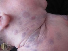 Neuroblastoma [dancing arms and legs, tender abdominal mass]

–Diagnostic tests?  ↑urine homovanillic or vanillylmandelic acid.

(blueberry muffin = blueish skin nodules)