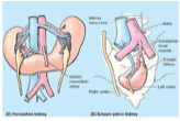 inferior poles of kidneys fuse and form a horseshoe, cannot ascend due to root of IMA and cannot rotate
generally not too bad, but can rupture in trauma