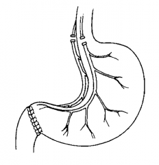 Pyloroplasty performed with vagotomy to compensate for decreased gastric emptying