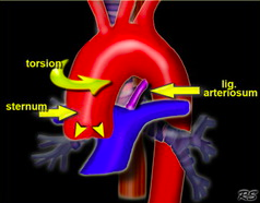 most often at the isthmus, which is tethered to the ligamentum arteriosum (which is relatively fixed and tethered unlike most of the adjacent descending aorta)