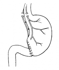 Truncal vagotomy, antrectomy, and gastroduodenostomy 


(Think B1 = ONE limb off of the stomach remnant)