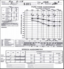 This audiogram illustrates____
The predicted SRT for the left ear would be ___dB HL.
Predicted SRS for the left ear would be___.
If the HL had been sensorineural a predicted SRS for the right ear would be___. A predicted MCL for the left ear is___...